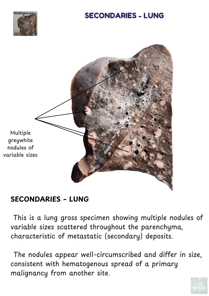 Secondary deposits - lung