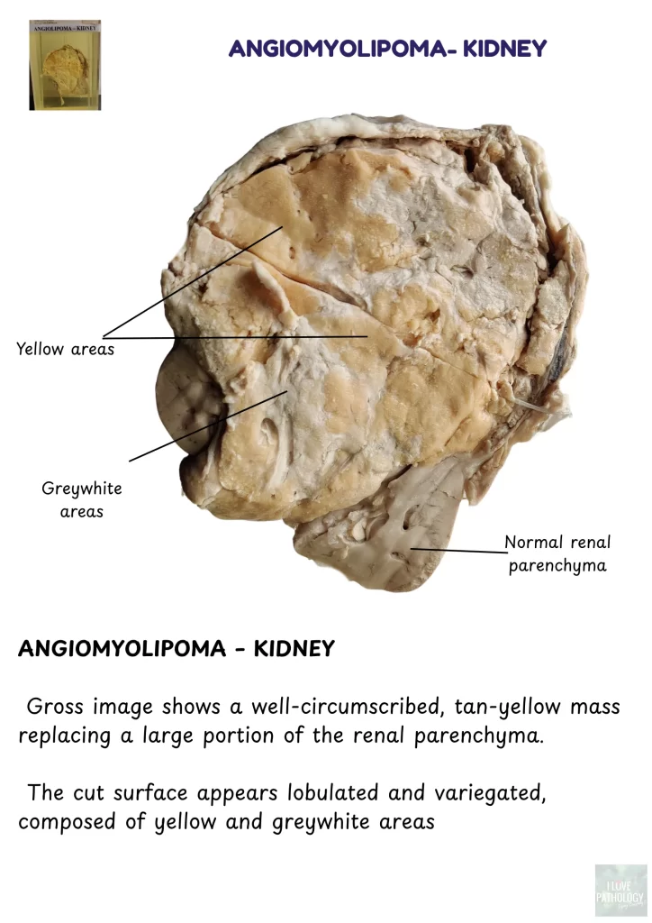 angiomyolipoma kidny