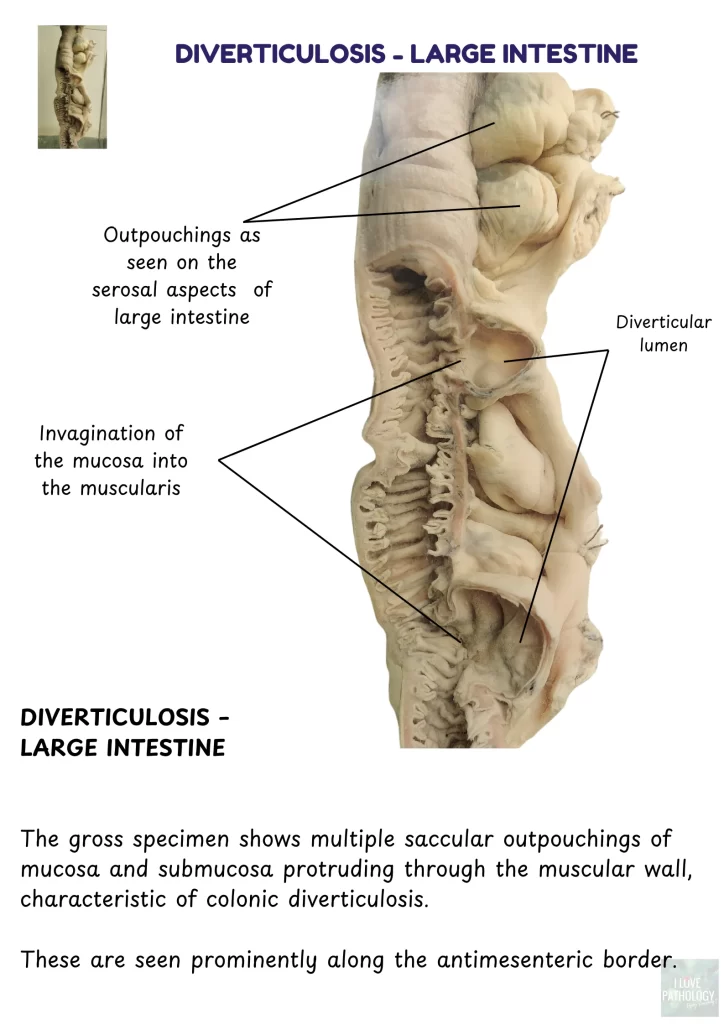 diverticulosis