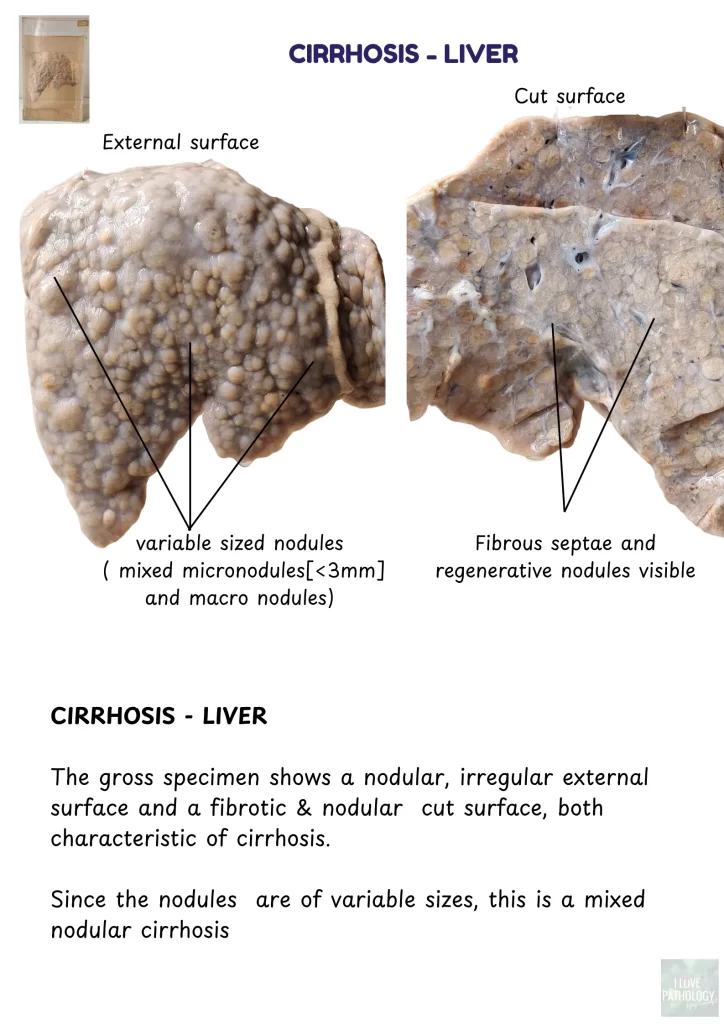 Cirrhosis - liver