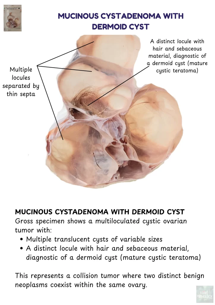 Mucinous cystadenoma with dermoid cyst