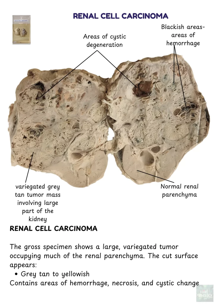 renal cell carcinoma