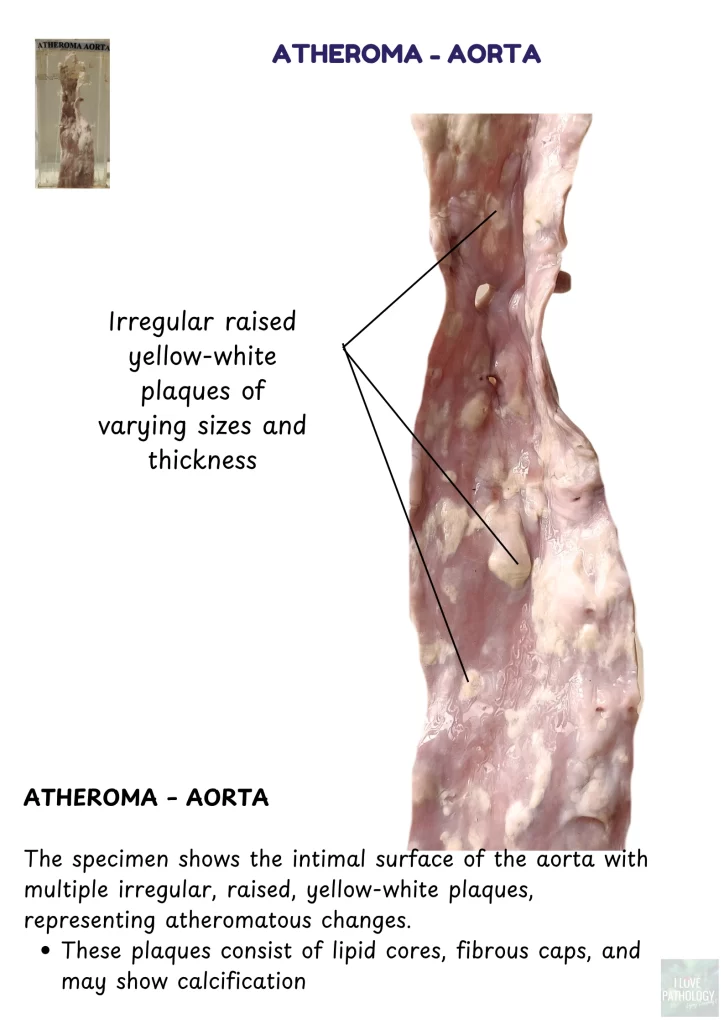atheroma aorta