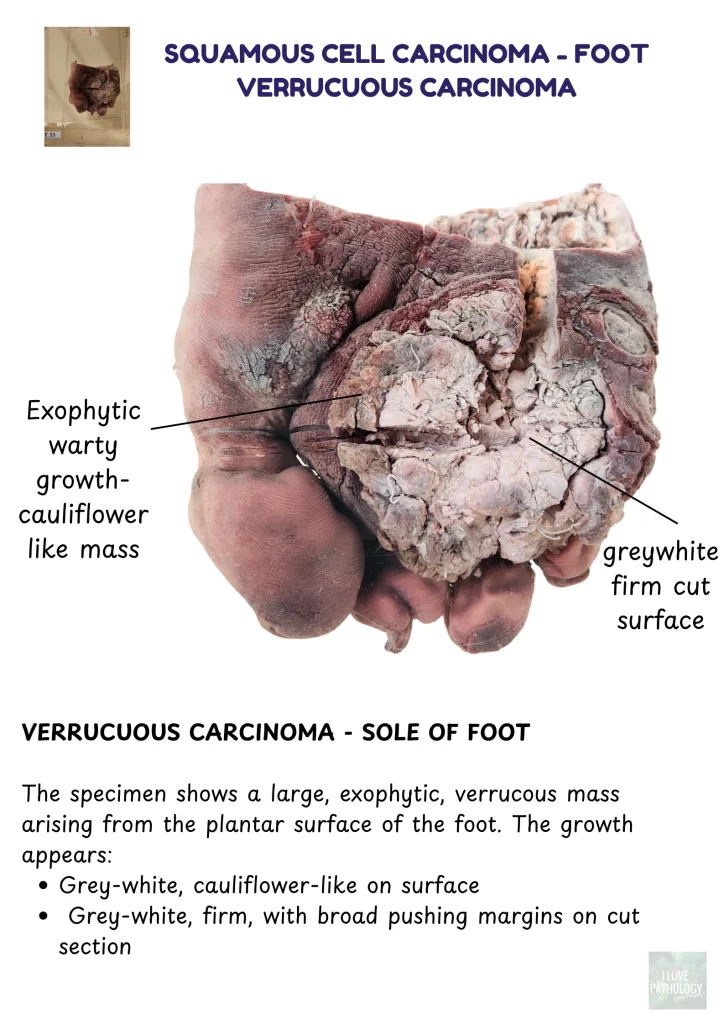 verrucous carcinoma foot