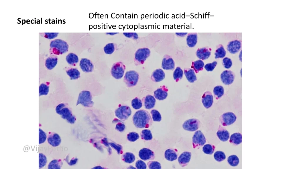 Acute Lymphoblastic Leukemia