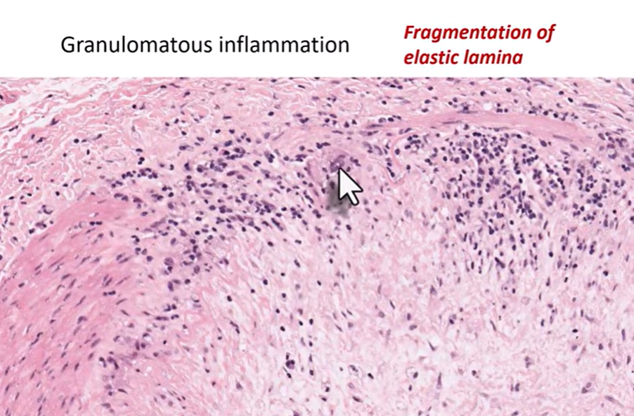 giant cell arteritis