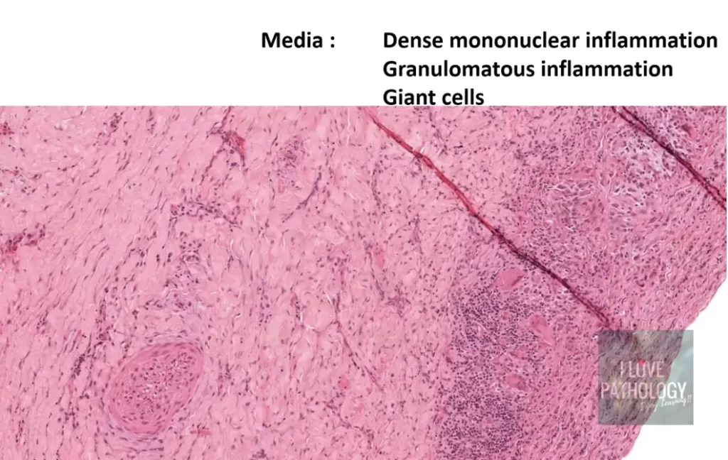 takayasu arteritis