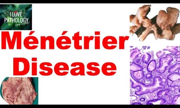 Ménétrier Disease