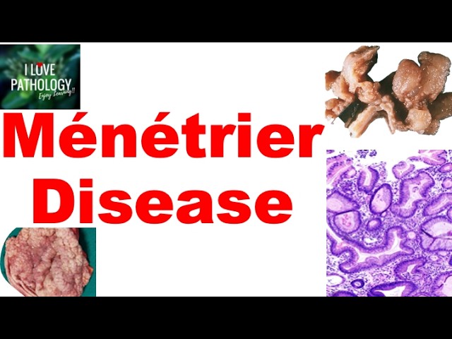 Ménétrier Disease